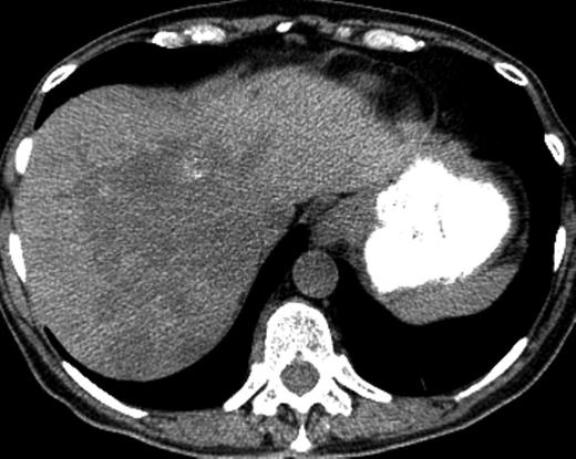 ) Glioma Intrahepatic Cholangiocarcinoma (IHCC) Chondrosarcoma Low grade and 2 ary GBM Bile ducts