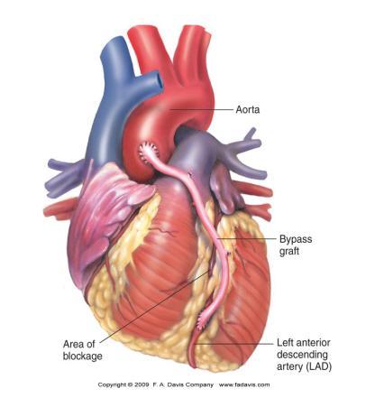 Coronary Artery Disease Cardiac Arrhythmias Congestive Heart Failure