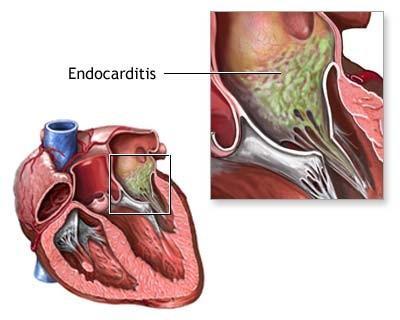 Endocarditis Inflammation of the heart s inner lining