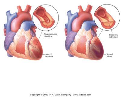 Paleness Coronary Artery Disease Narrowing of Coronary Arteries Usually due to