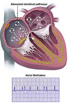 Fibrillation Atrial Fibrillation Risks of blood clots in atria Clots can be pumped to rest of body