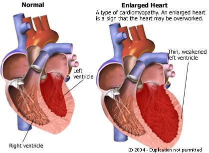 Cardiomyopathy Disease or weakening of heart muscle that leads to