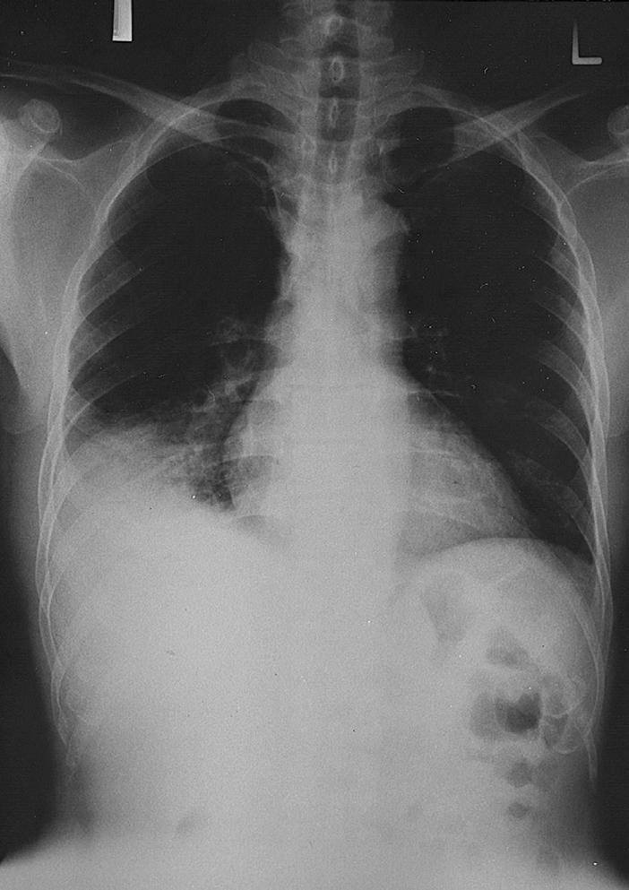 1 Interpreting Chest X-Rays CASE 1 Fig. 1.1 Case 1.