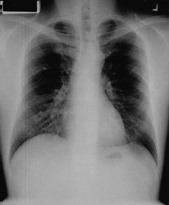 CASE 1 Interpreting Chest X-Rays 2 Fig. 1.2 SVC Ao LA RA LV CASE 1 PNEUMONIA The CXR shows a focal shadow in the right lower lobe with air bronchograms suggestive of pneumonia.