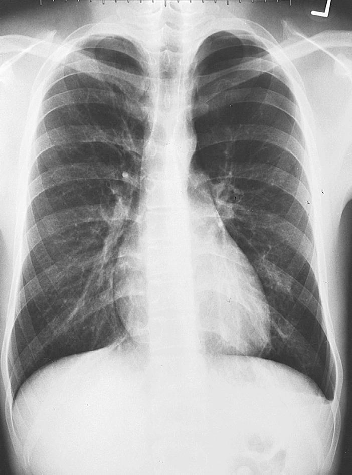 3 Interpreting Chest X-Rays CASE 2 Fig. 2.1 Case 2.