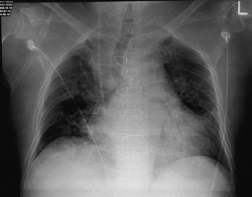 7 Interpreting Chest X-Rays CASE 4 Fig. 4.1 Case 4.