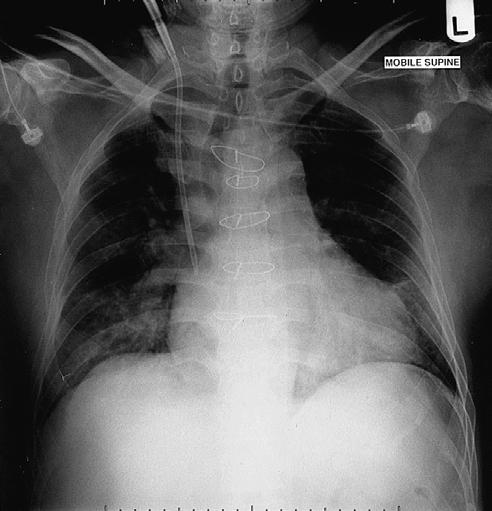 CASE 4 Interpreting Chest X-Rays 8 Fig. 4.2 CASE 4 CONGESTIVE HEART FAILURE The CXR shows classic evidence of left ventricular failure, i.e. cardiomegaly (cardiothoracic ratio 50%), upper lobe pulmonary venous diversion, and Kerley B lines (which indicate distension of lymphatics).