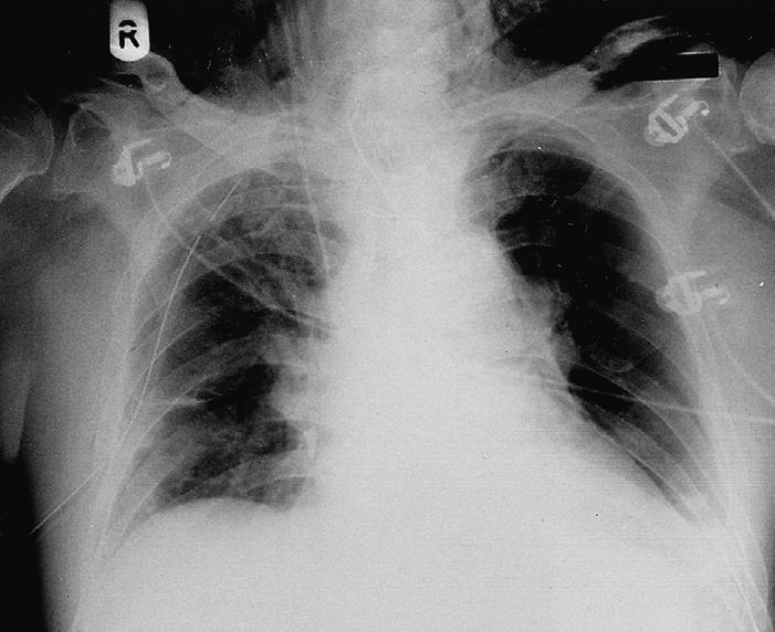 9 Interpreting Chest X-Rays CASE 5 Fig. 5.1 Case 5. A 65-year-old male presented with cardiogenic shock.