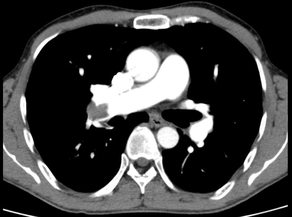 Pulmonary Embolus V/Q CTPA