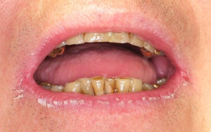 17 Angular cheilitis Consider fungal or bacterial infection