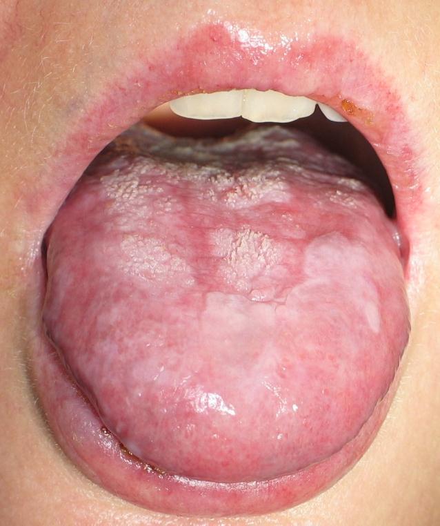 18 Chronic oral graft-versus-host disease Immunosuppressive treatment, topical or systemic Risk of infection Tongue, cheeks,
