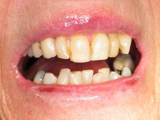 Case: Tonsil