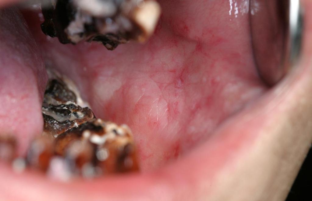 Chronic radiation damage to oral mucosa 6 epithelial atrophy