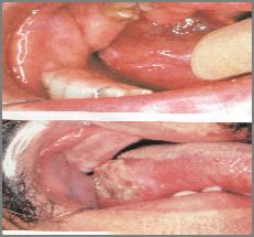 Neoplasm Squamous cell carcinoma (SCC) Most common