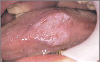 infiltrative or verrucoid Mimic benign lesions grossly