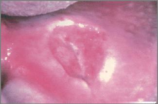 Ischemia to minor salivary glands Deep ulcers