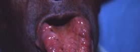 Amyloidosis of the Tongue : cutaneous and oral manifestations Erythema multiforme Lichen planus