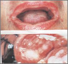 Erythema multiforme Lichen planus Chronic disease of skin and mucous