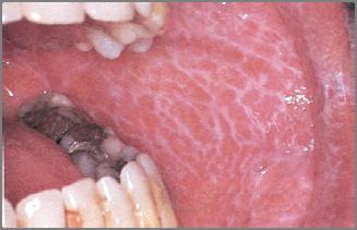 Reticular: fine, lacy appearance on buccal mucosa (Wickman s striae)