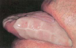 Sloughing (Nikolsky sign) Bullous pemphigoid Cutaneous lesions more common Both show