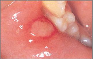 Recurrent Aphthous Stomatitis (RAS) Minor apthae Recurrent Aphthous