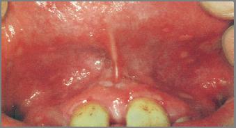 chills, malaise Vesicles ulcers crusting Anywhere in the oral cavity