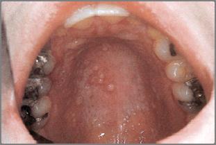 Herpesvirus Infection Secondary Infection Reactivation of latent virus Not associated with systemic symptoms Small vesicles Occur only on the hard palate and gingiva