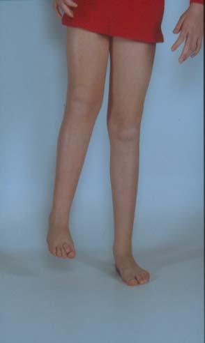 Childhood Presentation Deformity/contracture Limb length discrepancy»