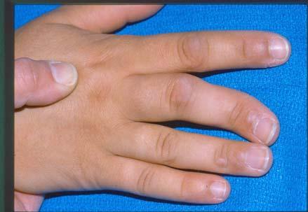 fingers, toes, knees, hips Angular deformity of bone, or at the