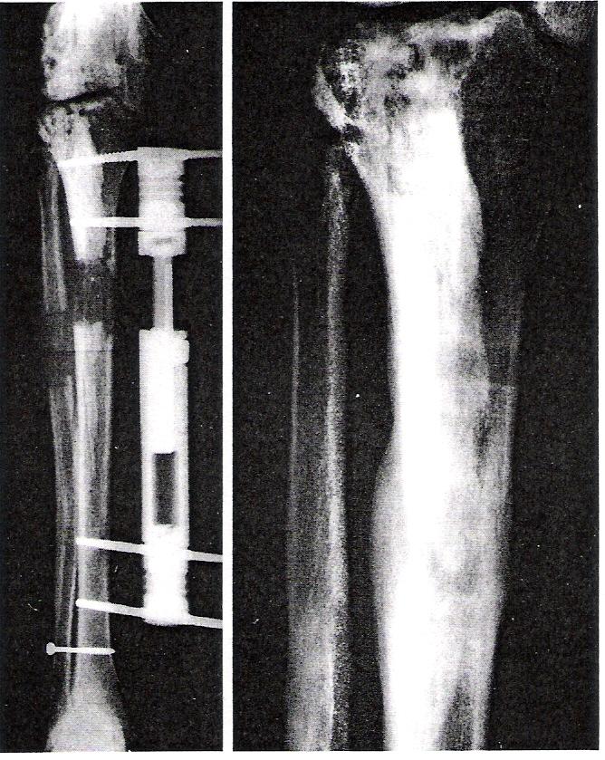 Limb lengthening» Several case reports of success Also for correction of joint deformity (Atar,, et al, Choi,, et
