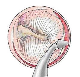 removed. A small opening into the inner ear is made using the laser and other instruments.