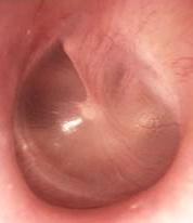 Ear Drum Perforation and other causes of Conductive Hearing Loss The ear drum (also known as the tympanic membrane) is the thin layer of skin that covers the deeper air-containing space called the