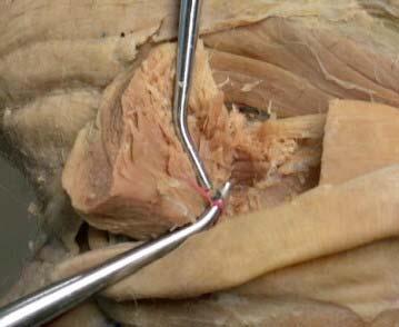 Suprascapular Artery Dorsolateral view, left side The suprascapular artery is a branch of the transverse scapular artery.