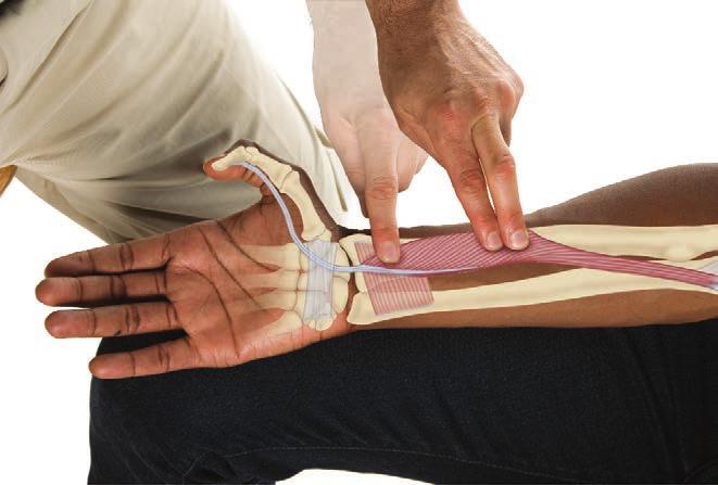 CASE STUDY: FLEXOR POLLICIS LONGUS Julie was a 25-year-old massage therapist who was experiencing tingling and pain into the median nerve distribution of her right hand, specifically the anterior