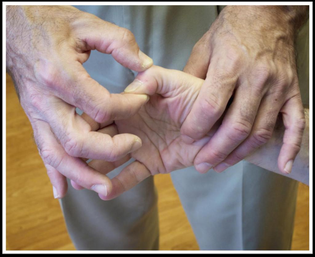 Tip of Examiner s thumb stabilizes the dorsum of patient s flexed 1