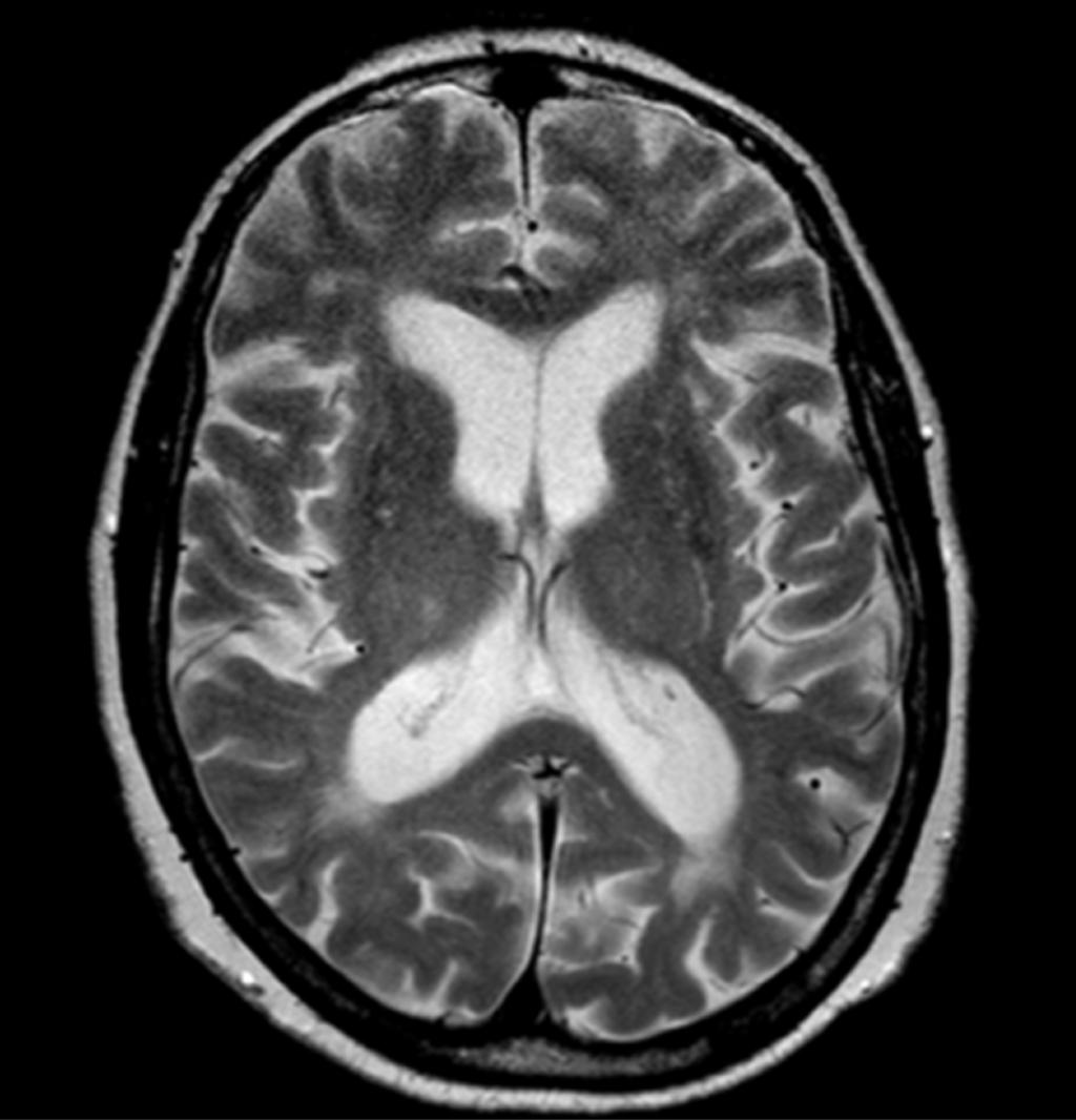 FLUIDS AND BARRIERS OF THE CNS Increased prevalence of cardiovascular disease in idiopathic normal pressure hydrocephalus patients