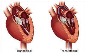 Trans catheter aortic valves (TAVI) Aspirin 81mg
