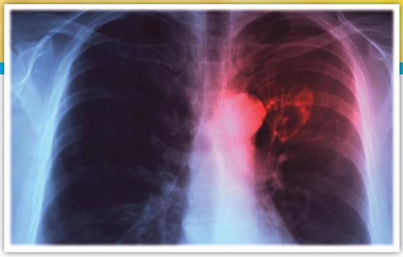 All you need to know about Tuberculosis What is tuberculosis? Tuberculosis is an infectious disease that usually affects the lungs.