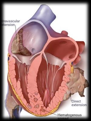 Cardiac Mass Cardiac tumors - Epidemiology - Primary benign tumors Myxoma Papillary fibroelastoma Lipoma Rhabdomyoma Fibroma - Primary malignant tumors - Metastatic tumors Non-tumors - Intracardiac