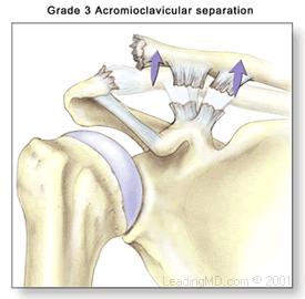 The clavicle is then aligned with the acromion and titanium screws are placed in the tunnels in order to keep the clavicle in place.