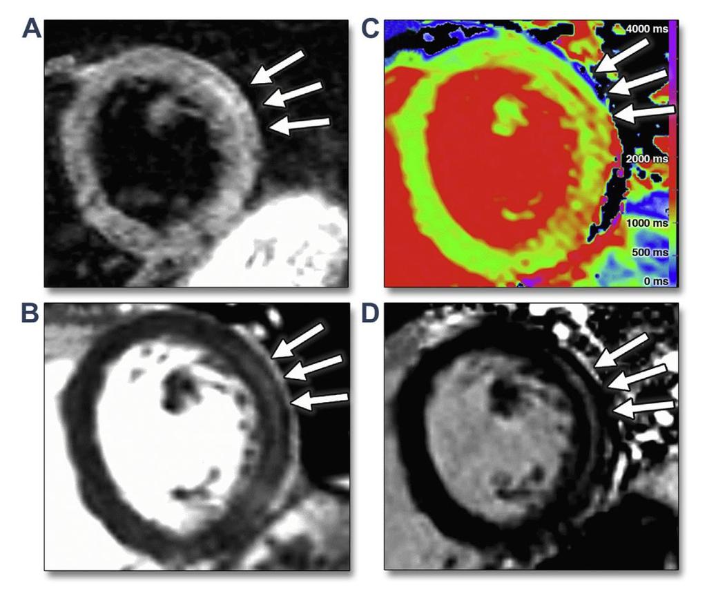 Improving Accuracy and Reproducibility Patients with suspected acute myocarditis 3D Strain T2 Mapping 50 patients suspected myocarditis 45 normal controls Mean LVEF 62 +/-