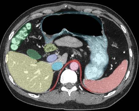 Duodenum Axial Image 2 Hepatic flexure Stomach