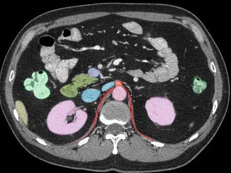 Axial Image 8 Left renal vein Pancreas Duodenum 2