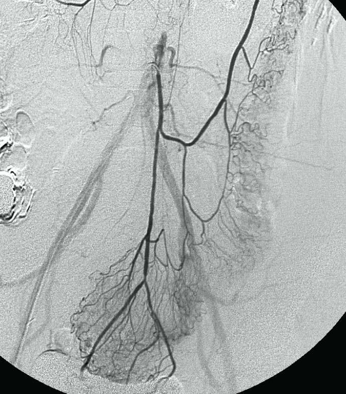 Inferior Mesenteric Artery- DSA* Inferior mesenteric Left colic