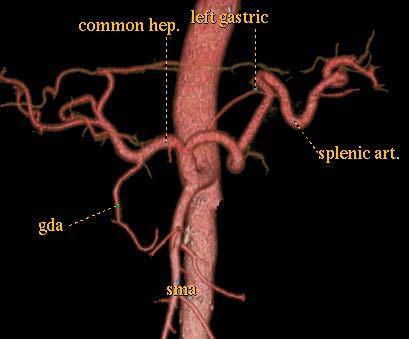 Common origin of celiac trunk and superior