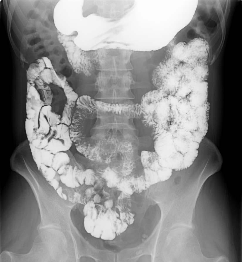 Small Bowel Follow Through Two circles highlight a jejunal segment (right circle) and an ilieal segment (left circle) Jejunal segments have markings or circular folds (plicae circulares / valvulae