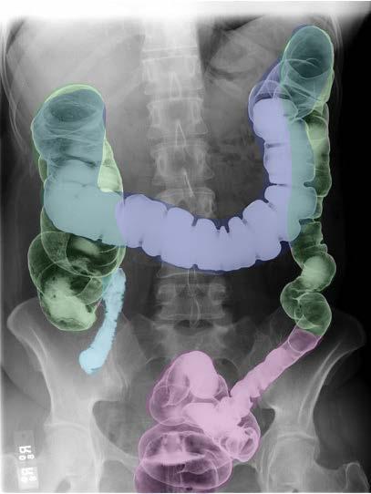 Barium Enema Hepatic flexure Ascending colon Appendix Transverse colon Splenic flexure Descending colon Sigmoid colon Which parts of the colon are