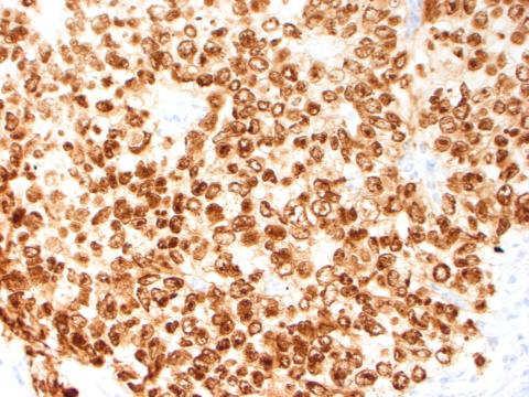 Immunohistochemistry of Embryonal Carcinoma Stain