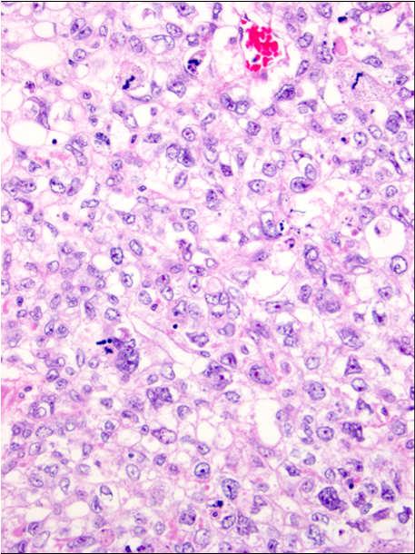 Yolk Sac Tumor Immunohistochemistry Stain Result OCT4 Negative SALL4 Positive, nuclei HNF-1 Positive, nuclei