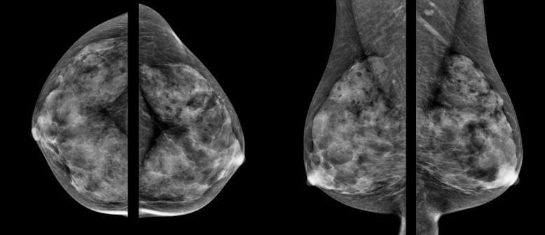 SenoBright Case Study Figure 4a: Original mammography from a 79 y/o patient who presented with palpable mass on